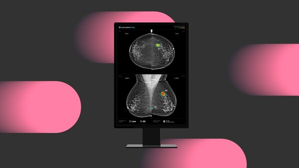 World's First Large-Scale, Multicenter Prospective Study in Single-Reading Mammography Confirms Lunit AI Boosts Cancer Detection