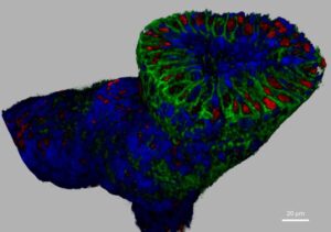 3D病理検査でHER2発現乳がん治療の精度が向上：新しいJelloX研究協力