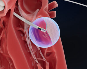 ヒトに対しては初となるField Medicalの6か月治療データがVTシンポジウム2025の最新臨床試験（Late-Breaking Clinical Trial）に選定